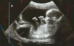 Infant in womb
